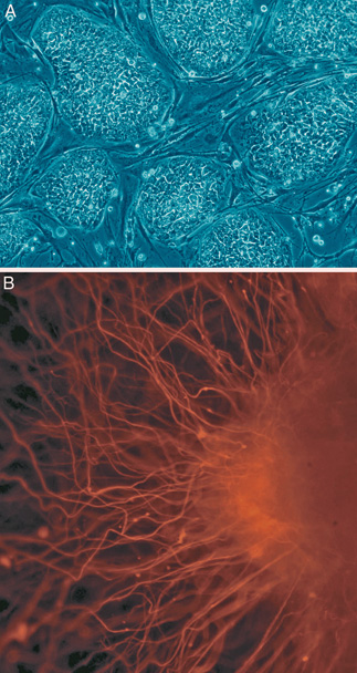 Neural Stem Cells Show Promise In Treating Rare Brain Disease