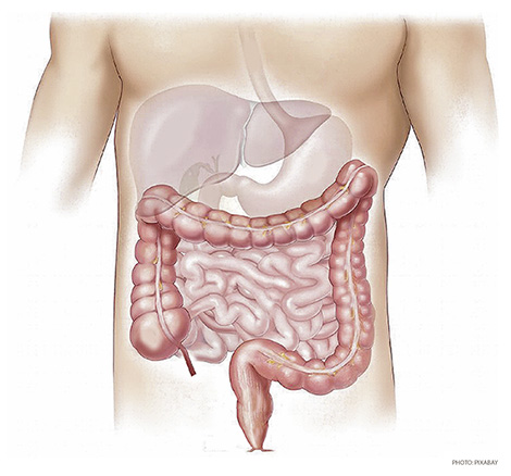 As More Young Americans Diagnosed with Colon Cancer, New Guidelines Lower Screening Age to 45