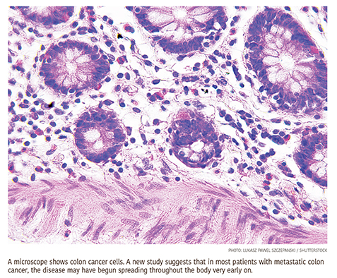 Many Advanced Metastatic Colon Cancers Were ‘Born’ Ready to Spread